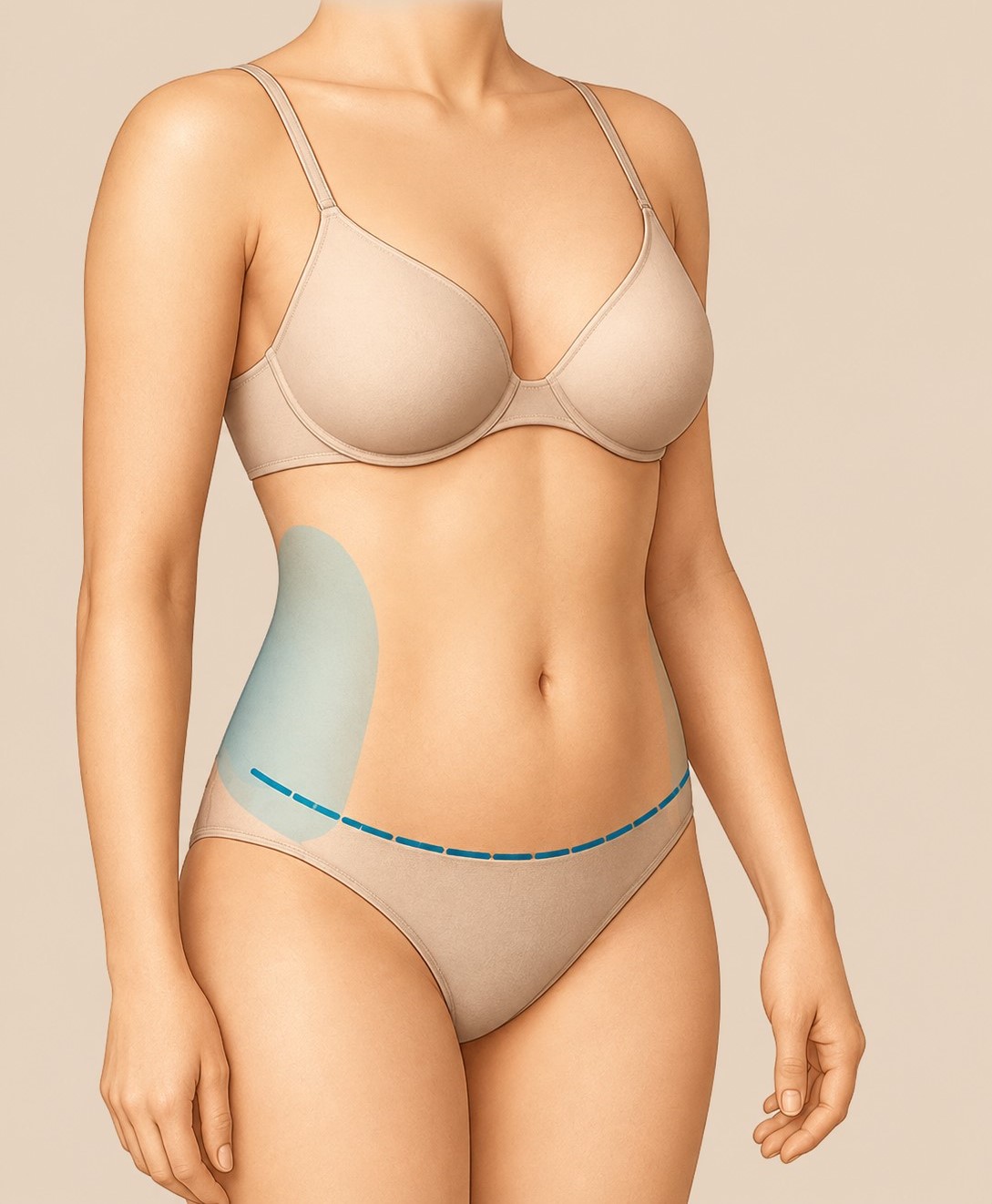 Extended Tummy Tuck