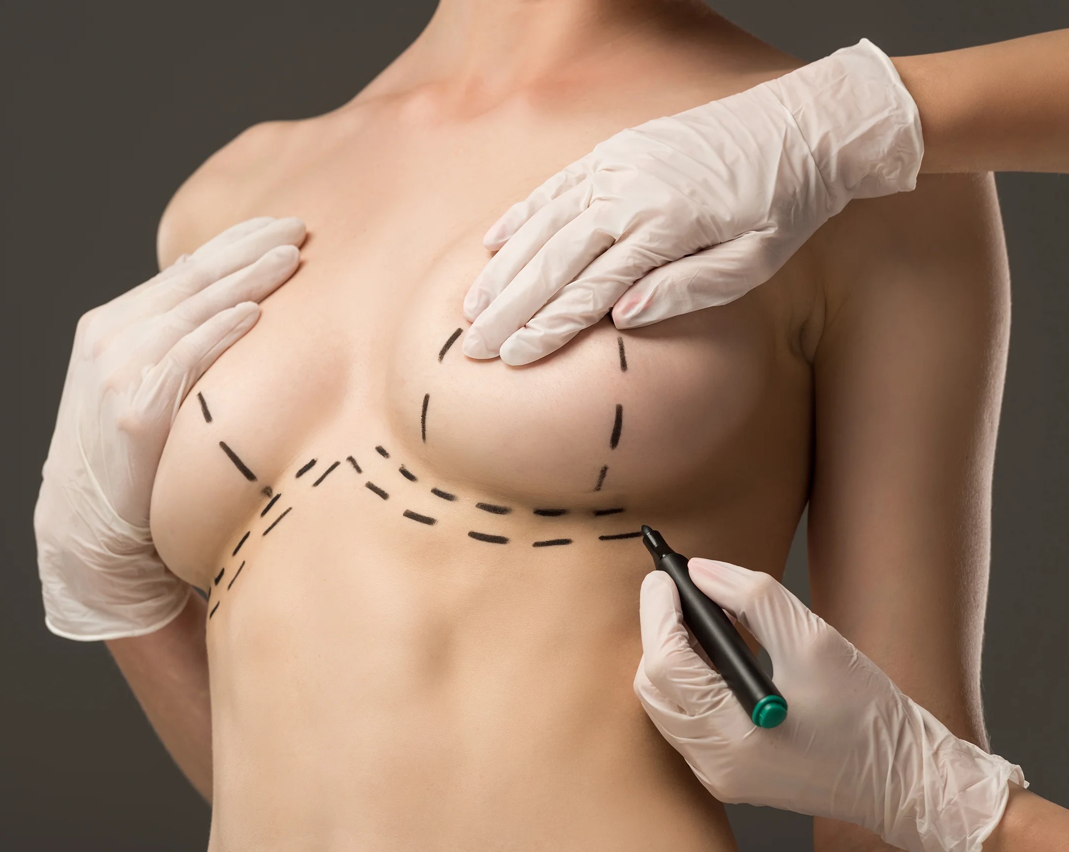 Breast Implant Revision
