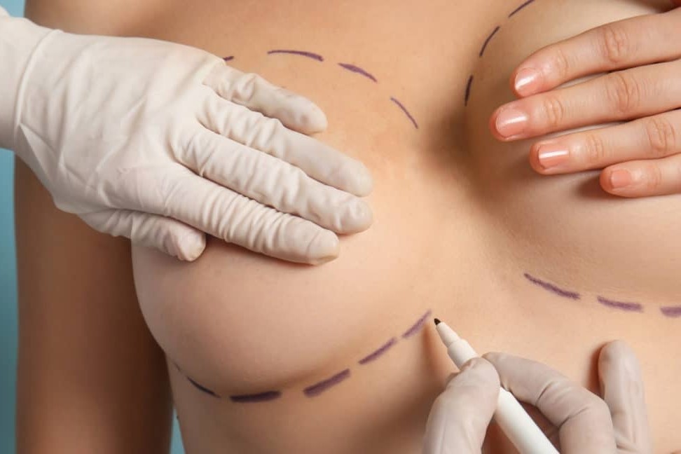 Fat Transfer Breast Augmentation