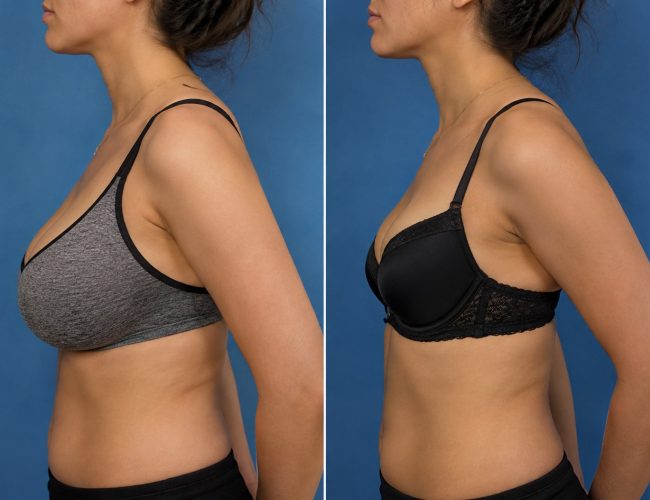 Breast-Reduction-1.jpg