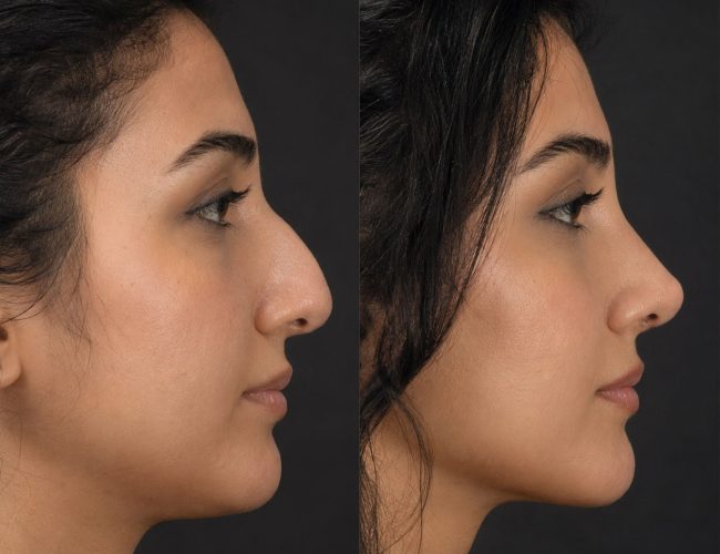 Rhinoplasty-1.jpg