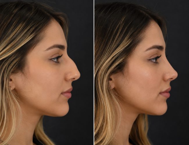Rhinoplasty-3.jpg
